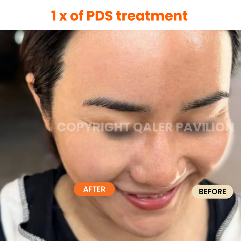 1st Trial PDS (Pigmentation Dark Spot Treatment)