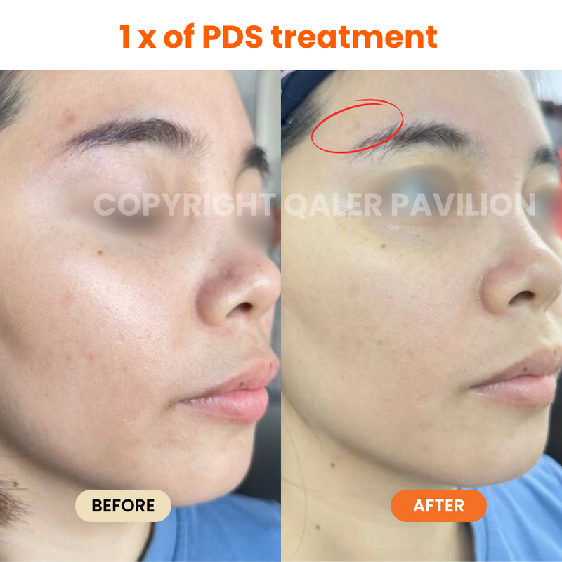 1st Trial PDS (Pigmentation Dark Spot Treatment)