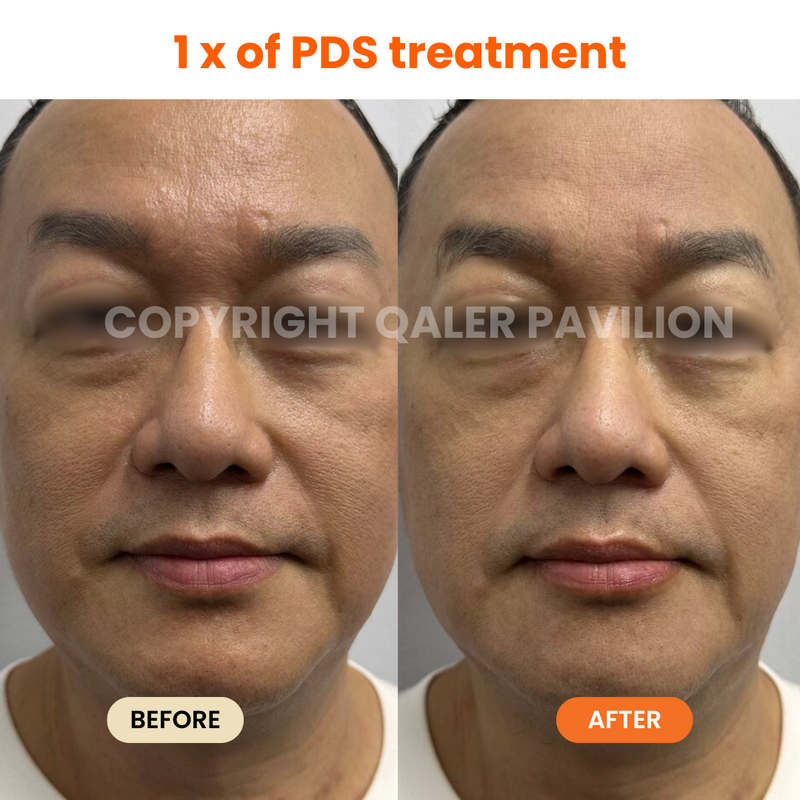 1st Trial PDS (Pigmentation Dark Spot Treatment)