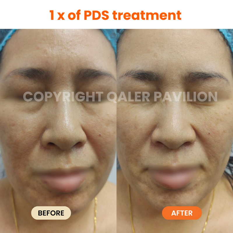 1st Trial PDS (Pigmentation Dark Spot Treatment)