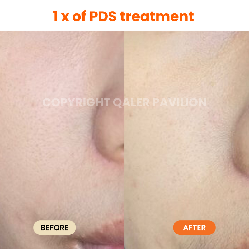 1st Trial PDS (Pigmentation Dark Spot Treatment)