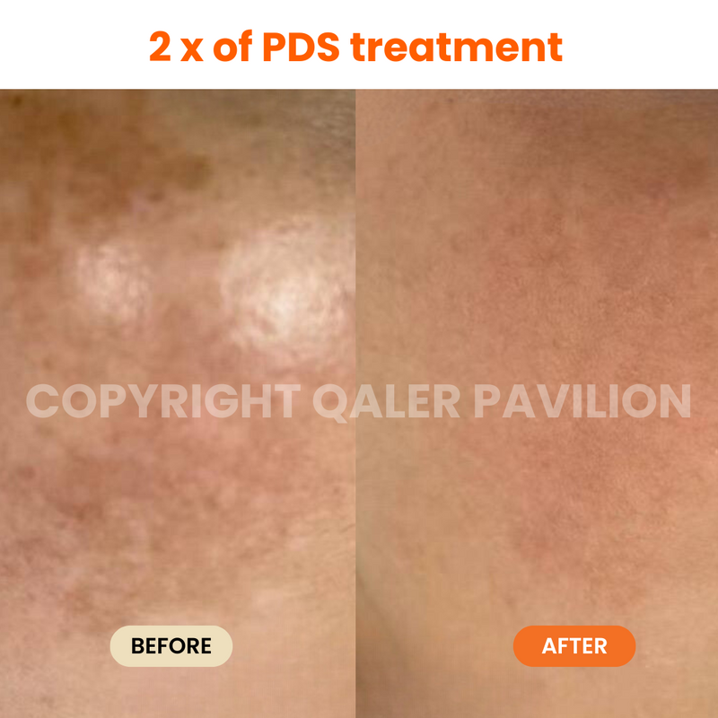 1st Trial PDS (Pigmentation Dark Spot Treatment)