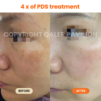 1st Trial PDS (Pigmentation Dark Spot Treatment)